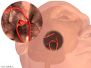 Aneurisma cerebral  uma doena na qual um vaso sanguneo encontra-se anormalmente dilatado no crebro. <br/><br/> Palavras-chave: Sistema Circulatrio, Sistema Nervoso, Medicina, Vaso Sanguneo, Crebro, Doena 