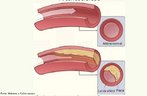 Corresponde ao acmulo de gordura nas paredes das artrias. Dependendo da regio que ocorre esse acmulo pode comprometer o funcionamento de rgos vitais.  <br/><br/> Palavras-chave: aterosclerose, colesterol, infarte do miocrdio, gorduras, artrias, excesso, obesidade. 