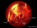 Etapa do desenvolvimento embrionário. No 8º mês de gestação o bebê coloca-se de barriga para baixo ( se ainda não o fez antes), a cada dia dispõe de menos espaço para se mexer. Os olhos se abrem na fase de alerta e se fecham durante o sono. O comprimento do feto é de aproximadamente 29 cm e seu peso é de 1800 g. <br/><br/> Palavras-chave: Embriologia, gestação, embrião, desenvolvimento. 