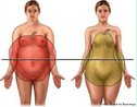 Há dois padrões de obesidade, a subcutânea e a visceral. A obesidade subcutânea localizada em baixo da pele, principalmente nádegas e coxas; as pessoas desse grupo tem a parte superior do abdômem mais fina que a inferior e por isso assumem aspecto de "pêra". É o padrão de obesidade feminina, ou seja ginecóide. A obesidade visceral, localizada principalmente dentro da cavidade abdominal, as pessoas que tem esse padrão de distribuição gordurosa geralmente tem cintura grande. Esse padrão lembra uma "maça” pois parece uma bola no centro do corpo. É o padrão de obesidade masculina, ou seja andróide. <br/><br/> Palavras-chave: obesidade, excesso de peso, patologias, calorias, desequilíbrio metabólico, genética, andróide, ginecóide. 