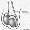 Corte dos canais deferentes, efetuado cirurgicamente atravs de uma inciso no escroto. Os espermatozides no se juntam aos lquidos ejaculados e so reabsorvidos no epiddimo. <br/><br/> Palavras-chave: Mtodo. Contracepo. Deferentectomia. Esterilidade.   