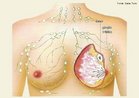 É o desenvolvimento anormal das células da mama, geralmente dos ductos mamários, as quais começam a se dividir e reproduzir muito rápido e de forma desorganizada. Estas células crescem e substituem o tecido saudável. Pode apresentar como sintomas: o aparecimento de nódulo ou endurecimento da mama ou embaixo do braço; a mudança no tamanho ou no formato da mama; alteração na coloração ou na sensibilidade da pele da mama ou da aréola; secreção contínua por um dos ductos; retração da pele da mama ou do mamilo; inchaço significativo ou distorção da pele e ou mucosas.  <br/><br/> Palavras-chave: anatomia, carcinomas, tumores, auto-exame, mamografia. 