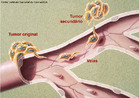 Processo que ocorre quando clulas cancergenas se reproduzem e se espalham pelo corpo formando novos tumores. <br/><br/> Palavras-chave: oncologia, cncer maligno, tumores, sarcomas, crescimento desordenado, clulas, citologia. 