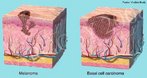 Tumor formado por melancitos (clulas produtoras de melanina, substncia que determina a cor da pele) que sofreram uma transformao e multiplicaram-se de maneira desordenada e anormal dando origem a um novo tecido(neoplasia). Entre as causas que predispem ao incio desta transformao celular aparece como principal agente a exposio prolongada e repetida  radiao ultra-violeta do sol. <br/><br/> Palavras-chave: tato, cncer de pele, radiaes ultravioletas, exposio prolongada, epiderme, derme, tumores. 