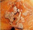 Doena causada pelo HPV (Papilomavrus Humano). O perodo de incubao pode levar anos ou de quatro  seis semanas. Apresenta pequenas verrugas no pnis, ao redor do nus, na vulva e na vagina.  tratado com uma cauterizao no local ou com uma interveno cirrgica para a retirada das verrugas. <br/><br/> Palavras-chave: DST. HPV. Cncer. Colo. tero. Papiloma. Condiloma. Sexo. 